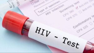 dunyada 408 milyon kisi hiv ile yasiyor turkiyede artis suruyor ZQzWHsYO.jpg